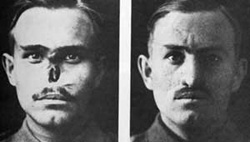 Kriegsverletzung: totaler Nasenverlust
